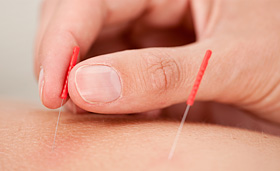 Acupuncture treatment